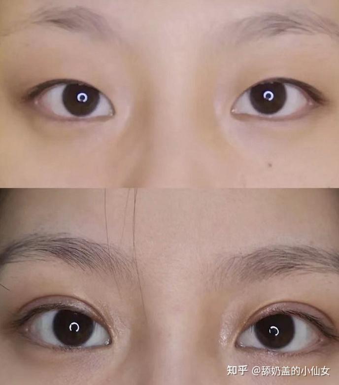 吊眼割什么形状的双眼皮比较好?