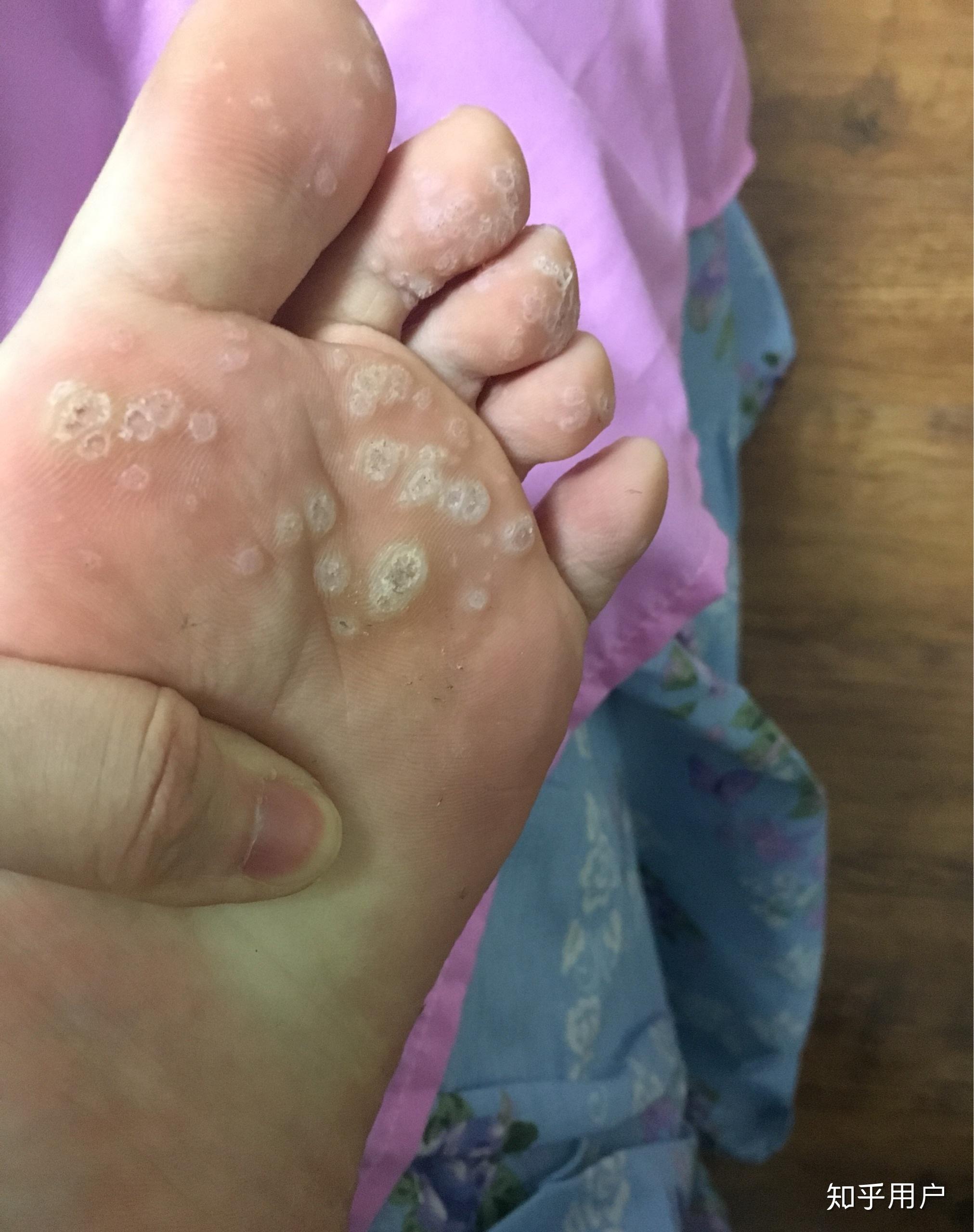 脚上感染长了疣怎么弄