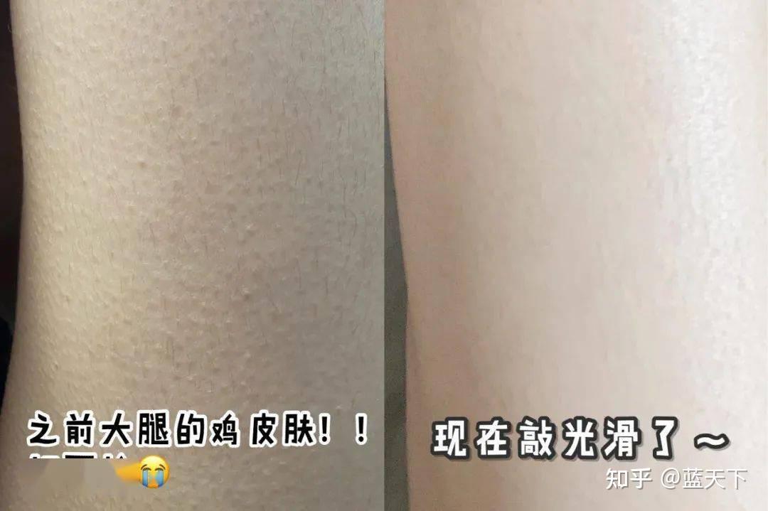 鸡皮肤短裤都穿不了(鸡皮肤想穿短裙怎么办)
