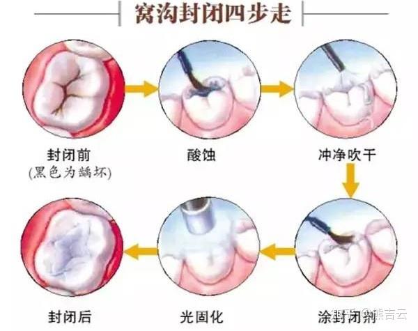 浅龋、中龋补牙就可以,深龋牙髓炎要怎么办? - 知乎