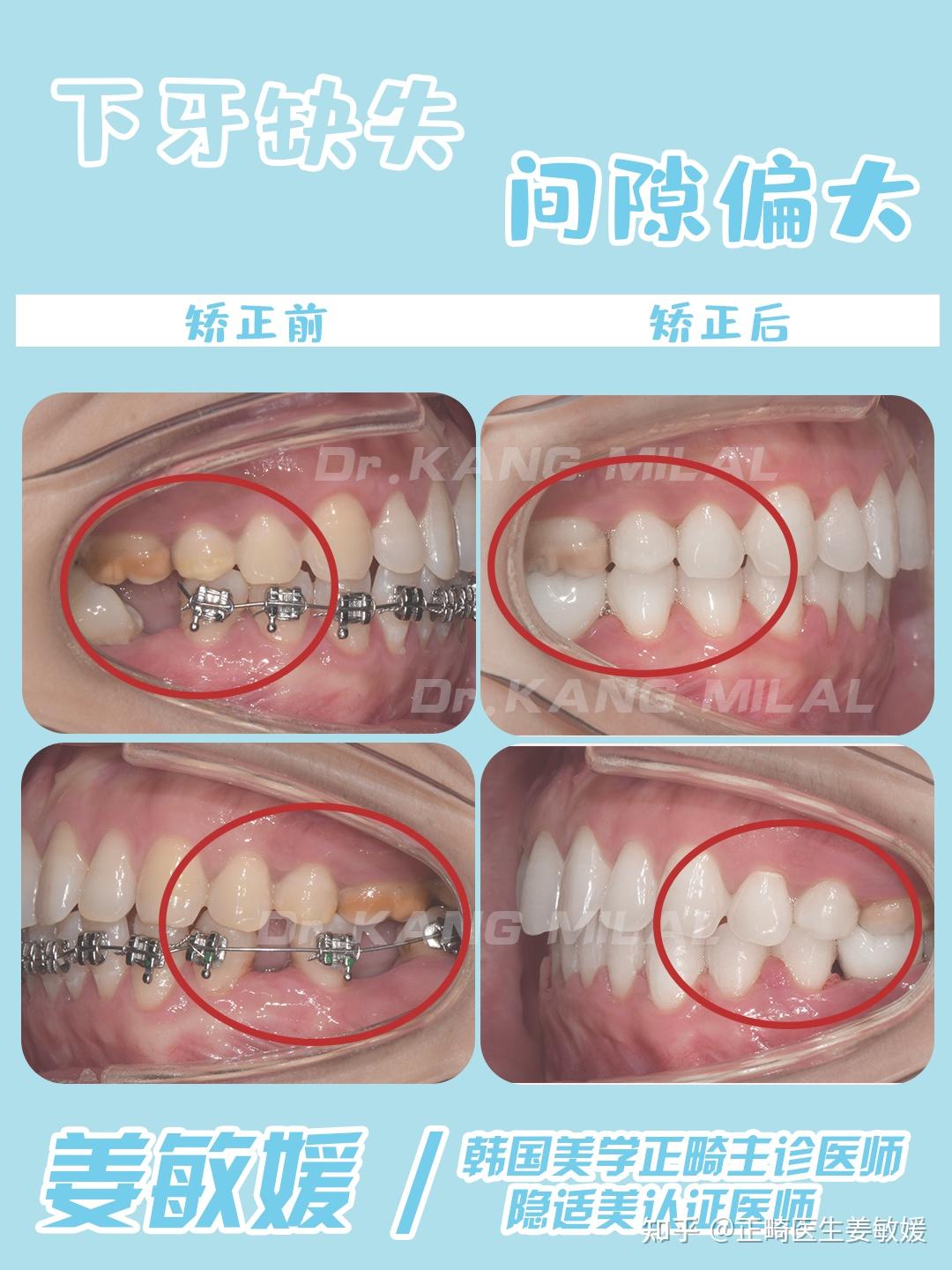 缺失牙的缺失牙，缺失牙的几种修复方式及适应人群和优缺点 - 知乎