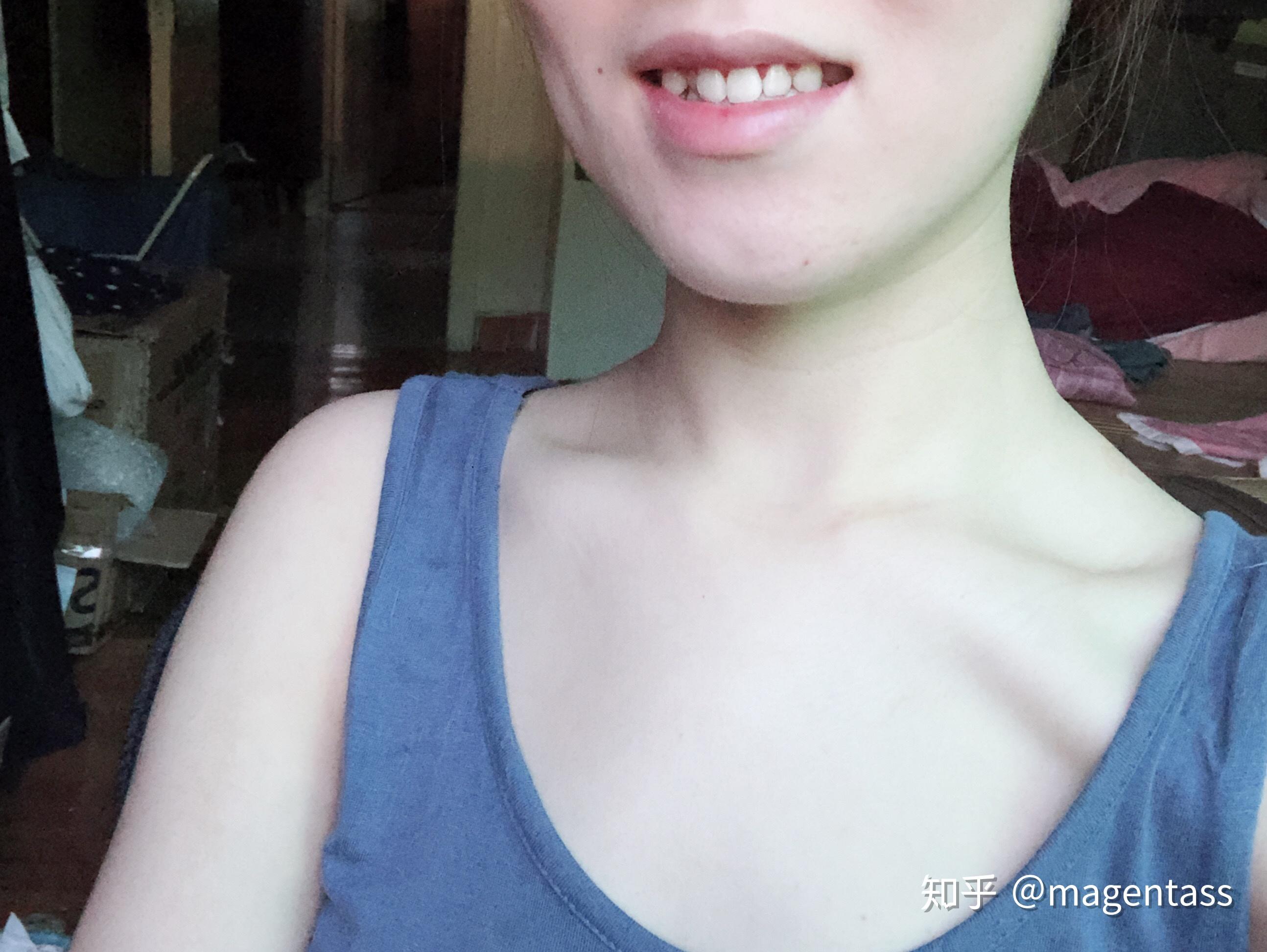平胸手术有什么危害 做了平胸手术后悔了