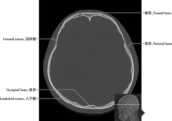 详细标注版!颅脑CT正常解剖图谱 - 知乎
