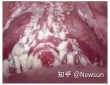 外阴瘙痒 豆腐渣样白带该怎么办 知乎