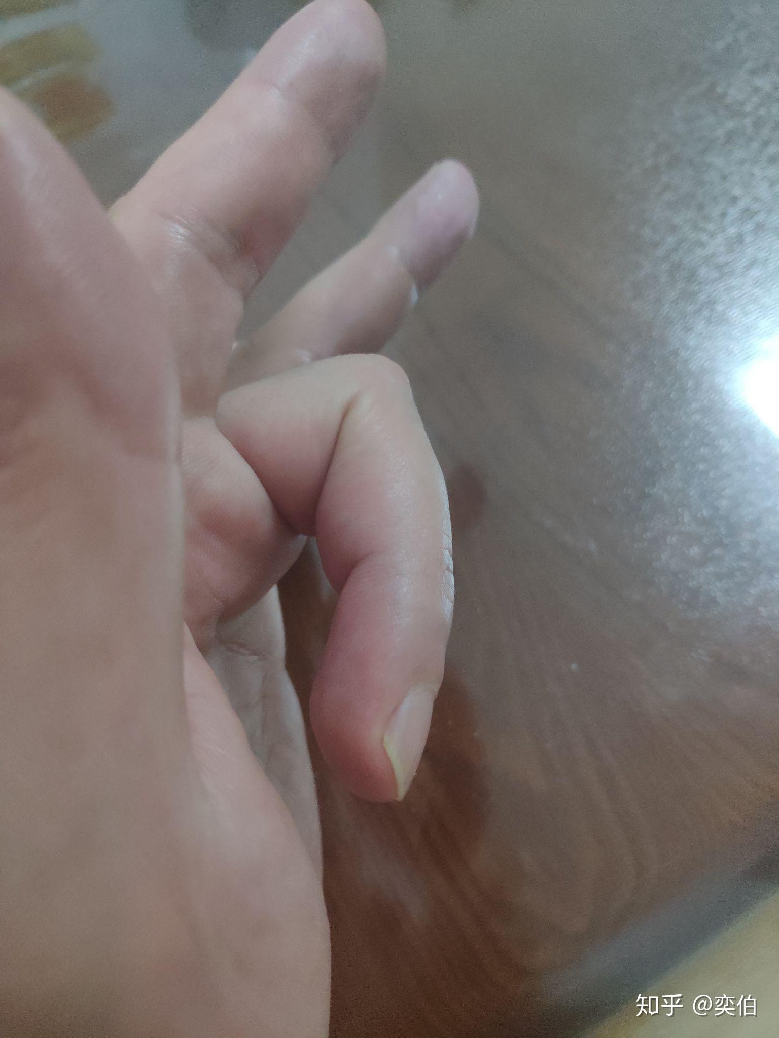 左手中指末端伸肌腱断裂