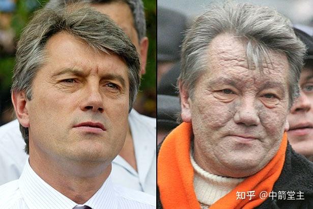 20231129乌克兰必胜乌军情局长布达诺夫妻子重金属中毒病危俄罗斯人