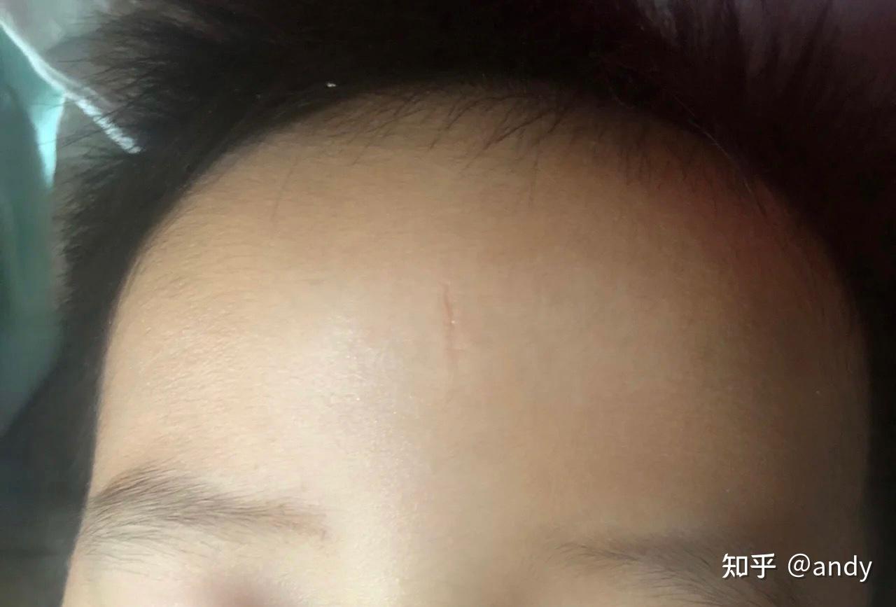 怎么淡化缝针后的疤痕? - 知乎