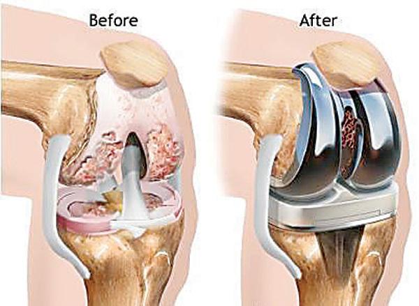 膝关节置换术示意图及部分手术风险解读- 知乎