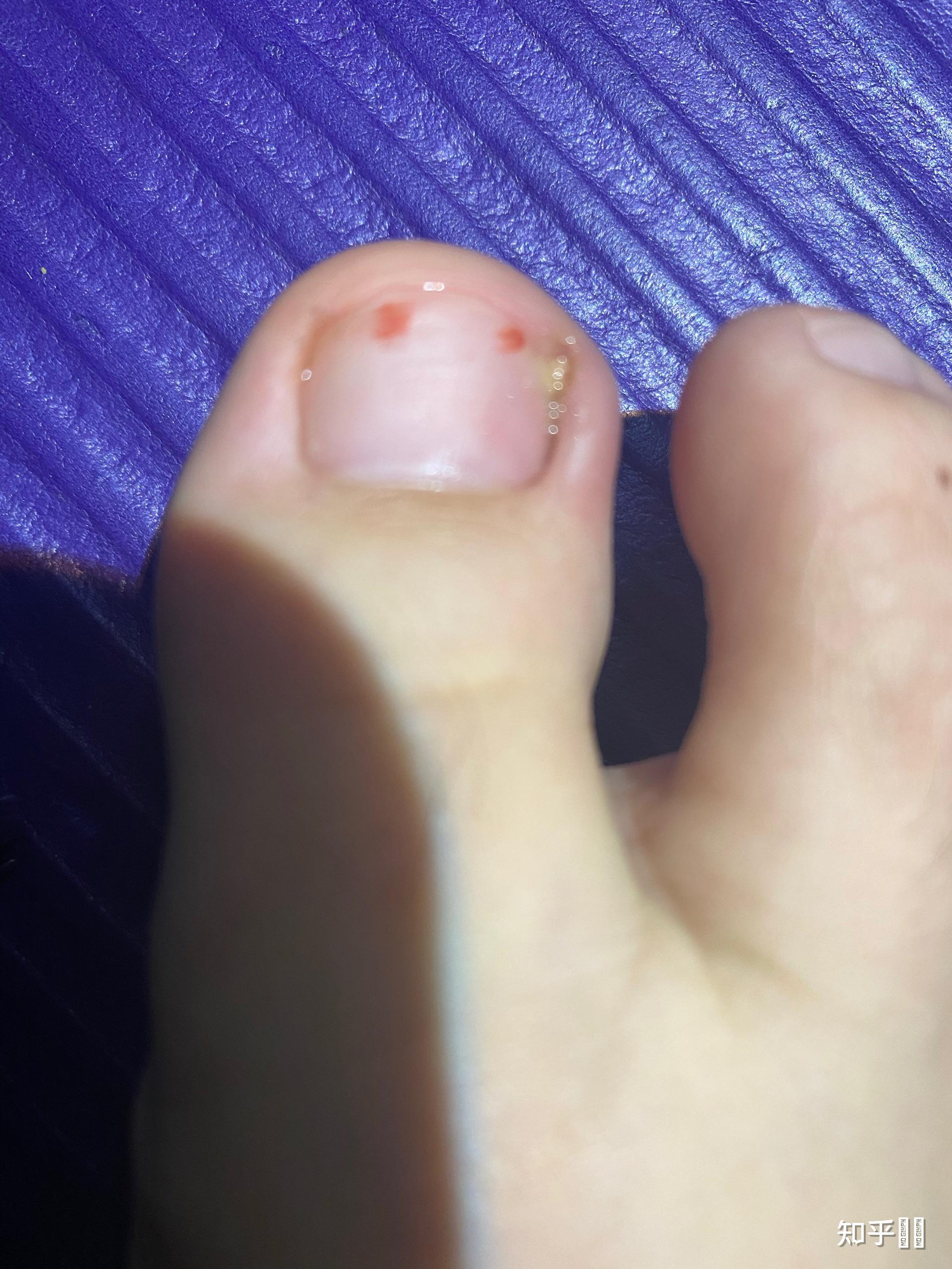 女友得了甲沟炎,大母脚趾甲长到肉里面了,走路就疼.