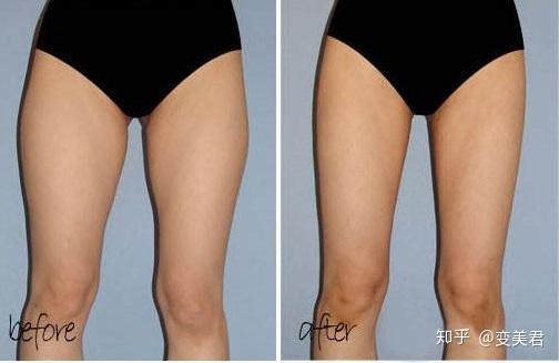 大腿吸抽脂术前必看 包括术后恢复过程和护理注意事项 知乎