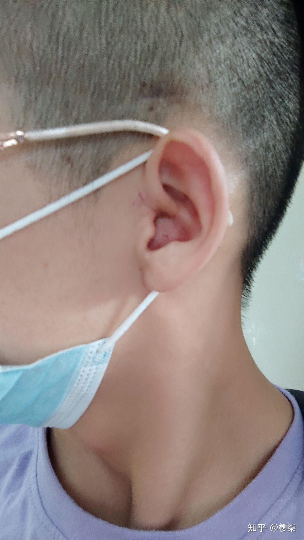 耳膜修补手术经历 