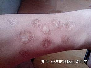 胥肖琴医生讲解：身上留下的烟疤怎么去除？ - 知乎