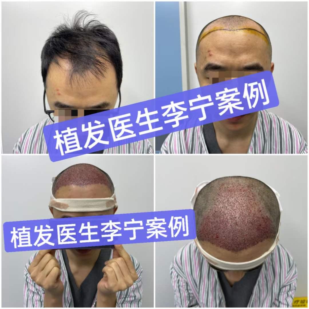 王恒植发(国内最好的植发专家)