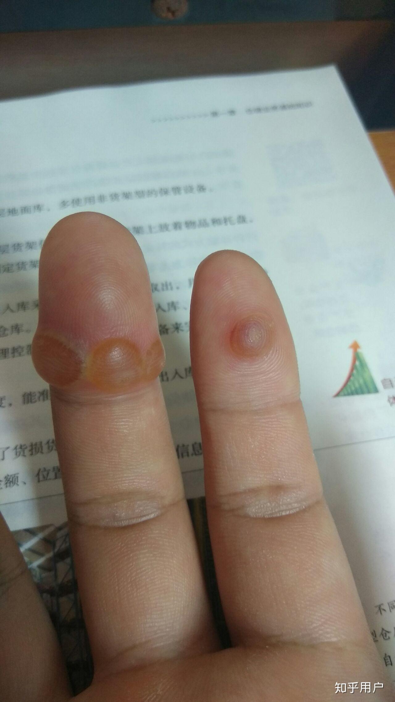 甲下寻常疣做液氮冷冻疼哭了,可耐受疼痛真的这么厉害吗?