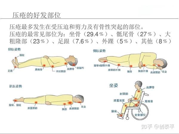 压疮(褥疮)的特点、分类及危害 - 知乎