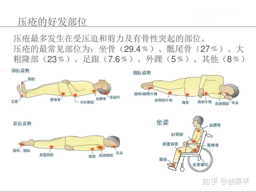 压疮(褥疮)的特点、分类及危害 - 知乎