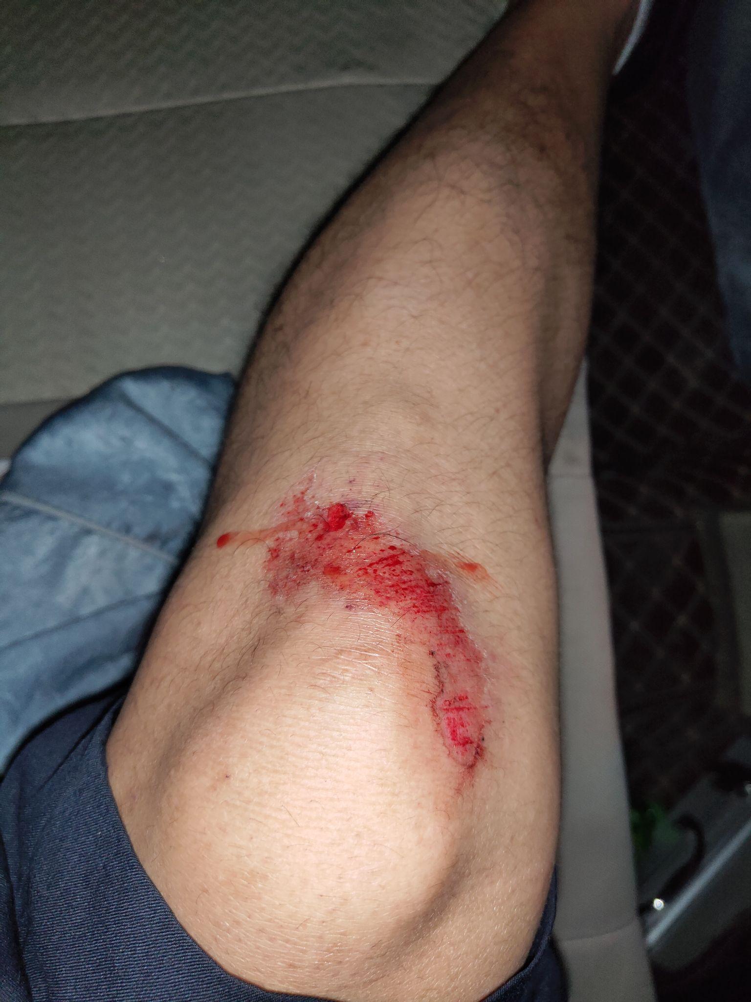 男生膝盖摔伤流血照片图片