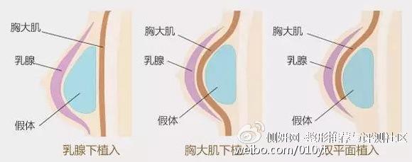 丰胸假体放多大的好 假体丰胸植入过大的风险 知乎