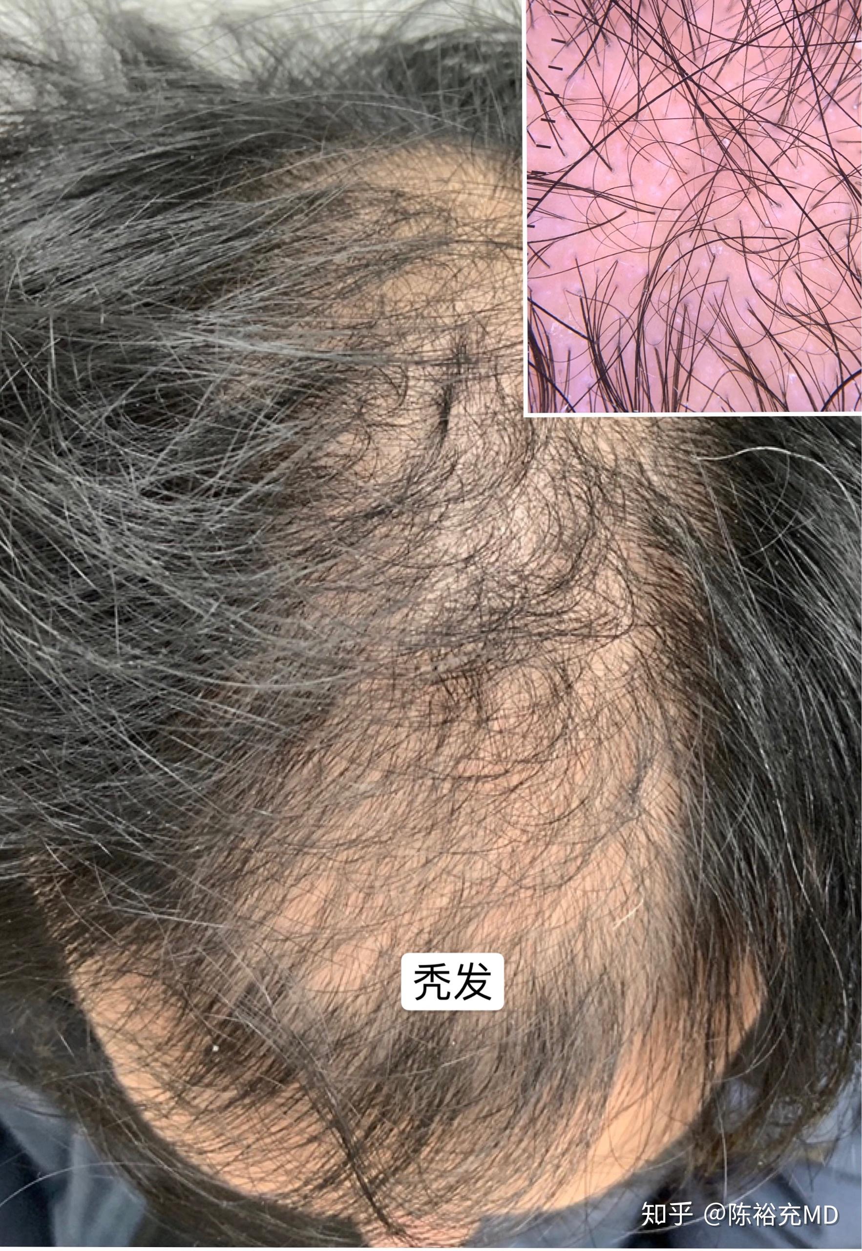 秃发与脱发 - 知乎