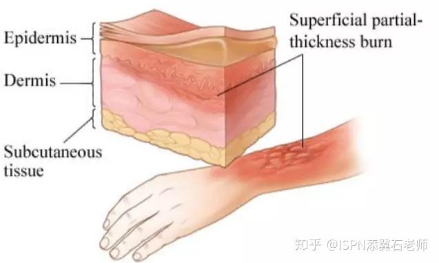 百分之百正确的小技巧快速分辨烧伤分度妙算烧伤面积