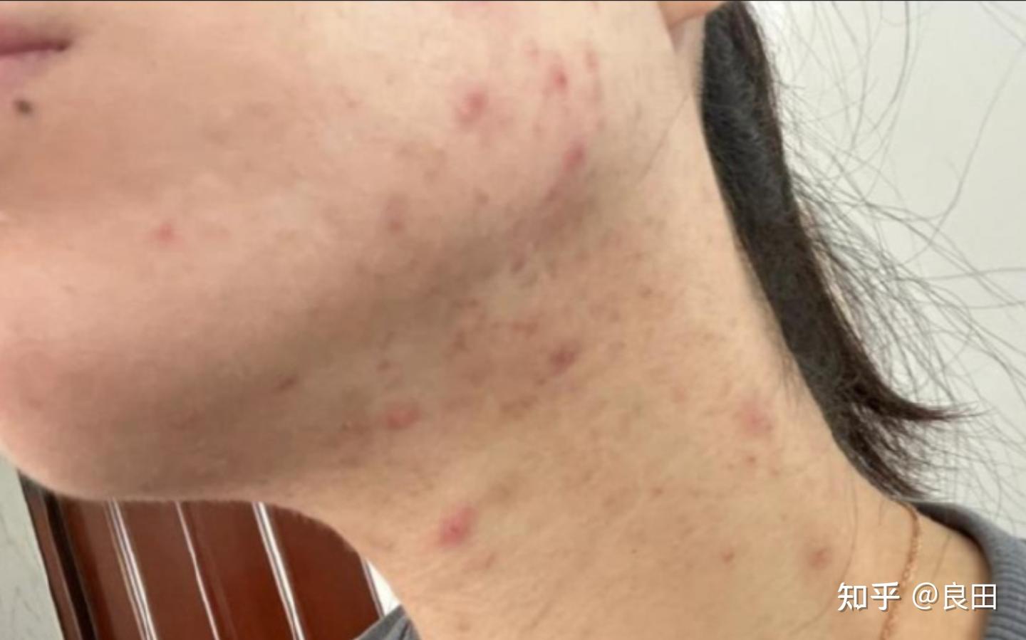 25岁,腮边爆了很多痘痘反反复复去不掉咋办? - 知乎