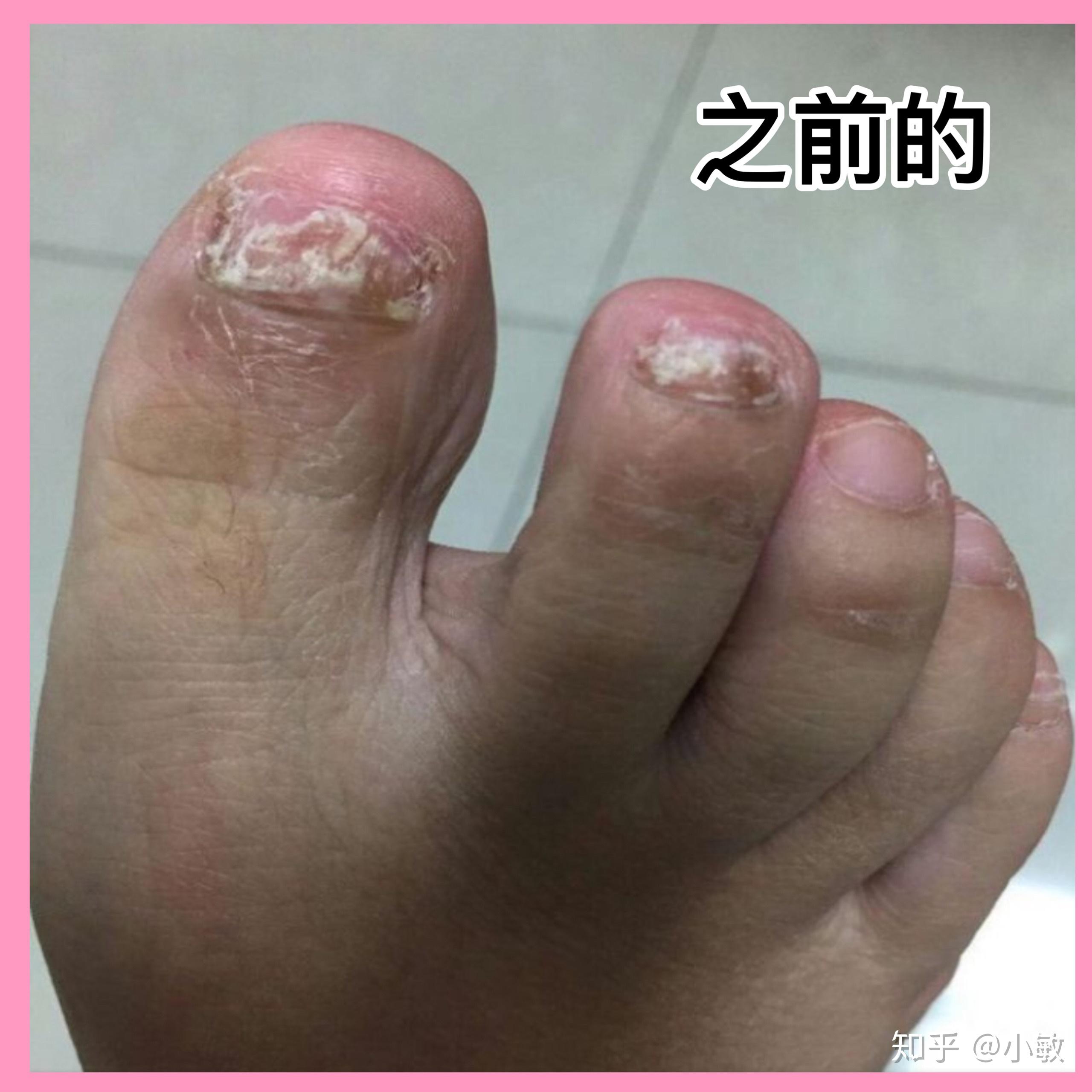 纯干货分享92灰指甲治疗方法