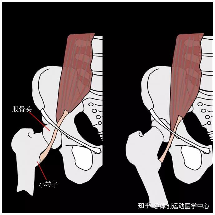 大腿根老是無緣無故的啪啪響原來是彈響髖惹的禍