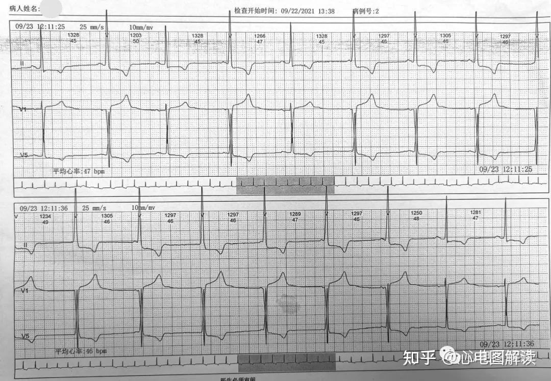 室性逸搏心律图片图片