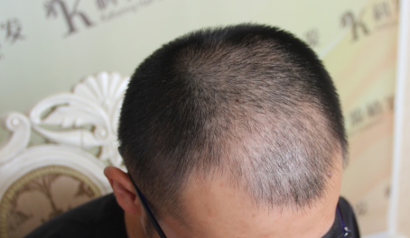 女生22,三年前发现头发越来越少,头发细软少,医