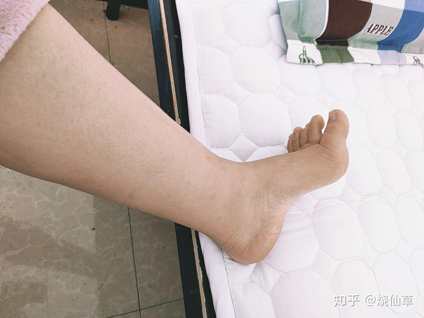 没有脚踝是怎么样一种体验