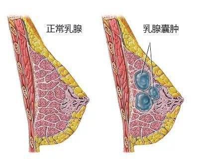 一味中成药搭配逍遥丸专治女性各种乳腺结节增生囊肿