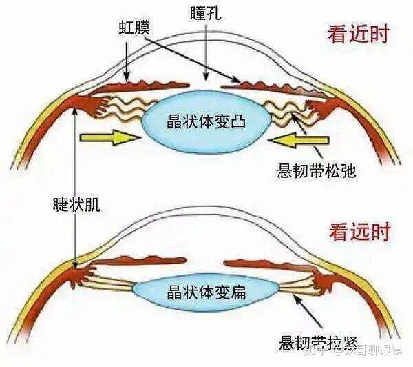 成年人單眼弱視,另一隻近視,如何防止近視度數進一步加深? - 知乎