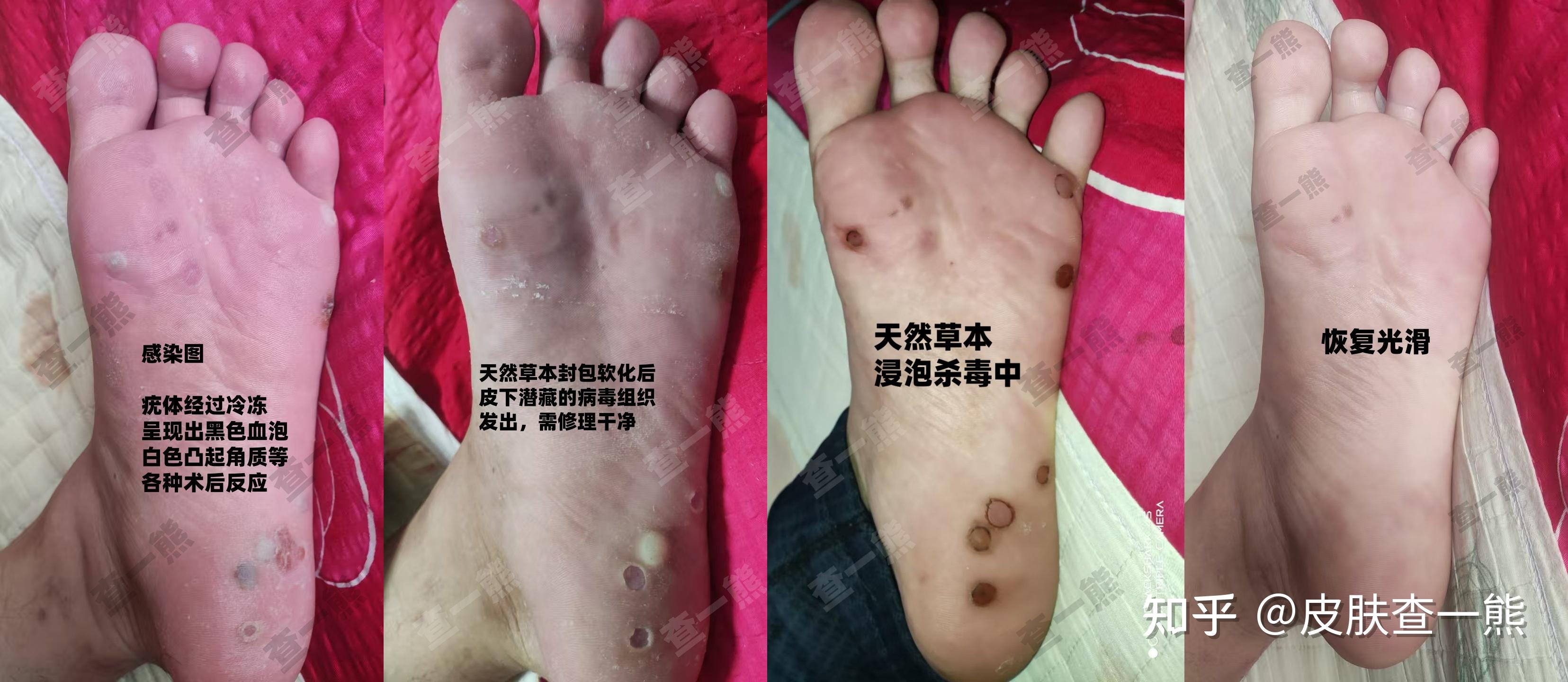 脚上长了好多跖疣怎么彻底治疗? - 知乎