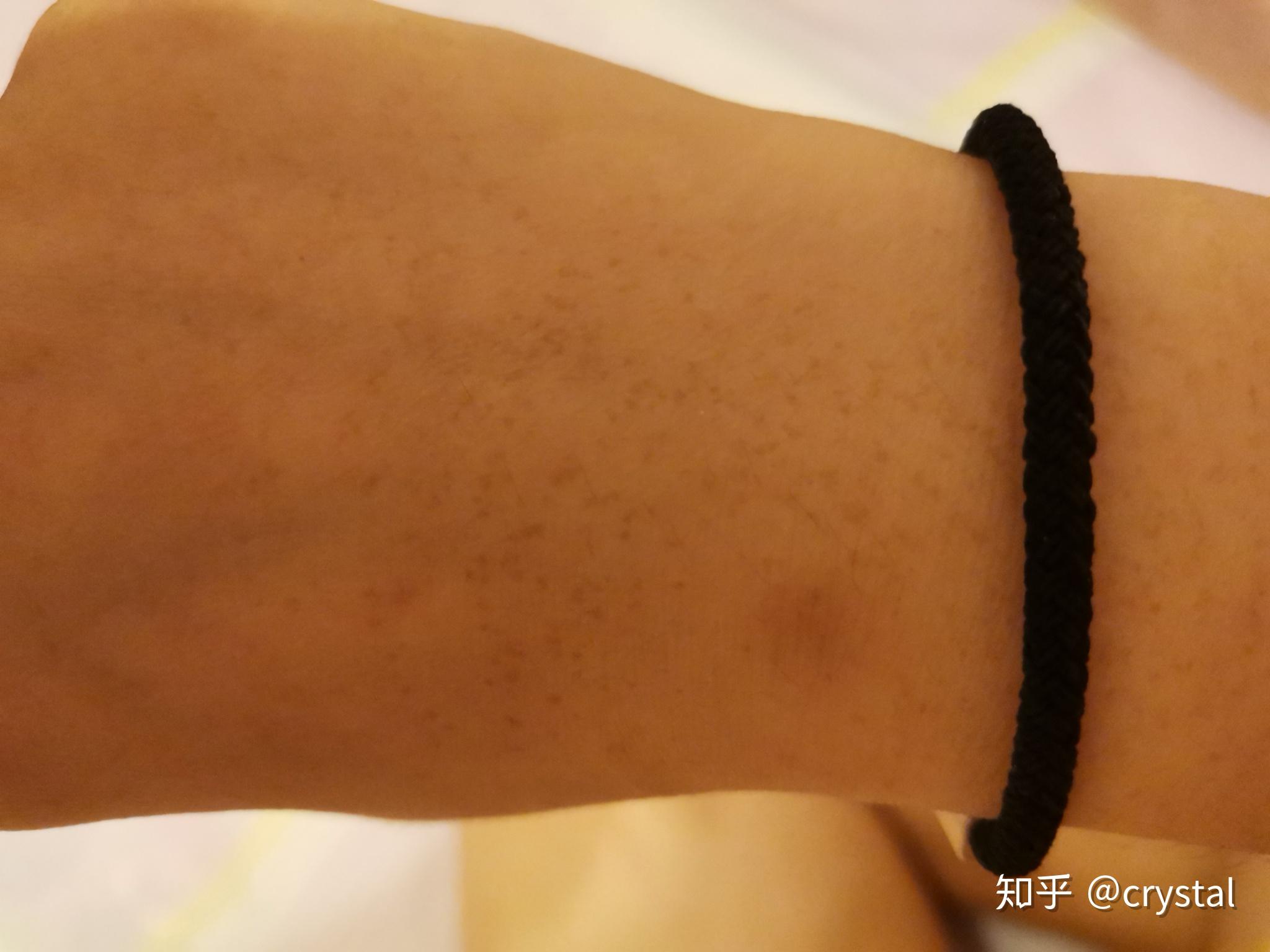 手臂的这是什么斑? - 知乎