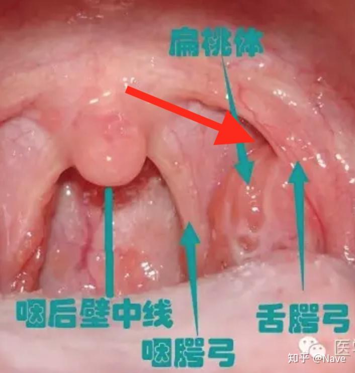 看知乎上那么多人都能自己清理扁桃体结石就我不能为什么