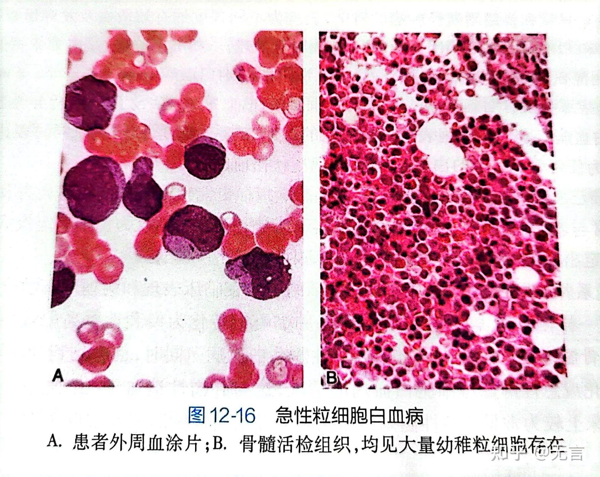 白血病的最初症状是什么? - 知乎