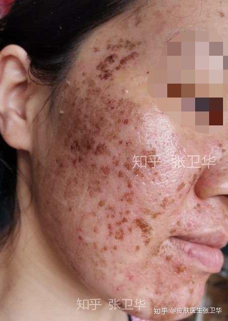 剥脱性点阵激光术后持久潮红,并发肤色不均,网格印和色沉反黑这些问题
