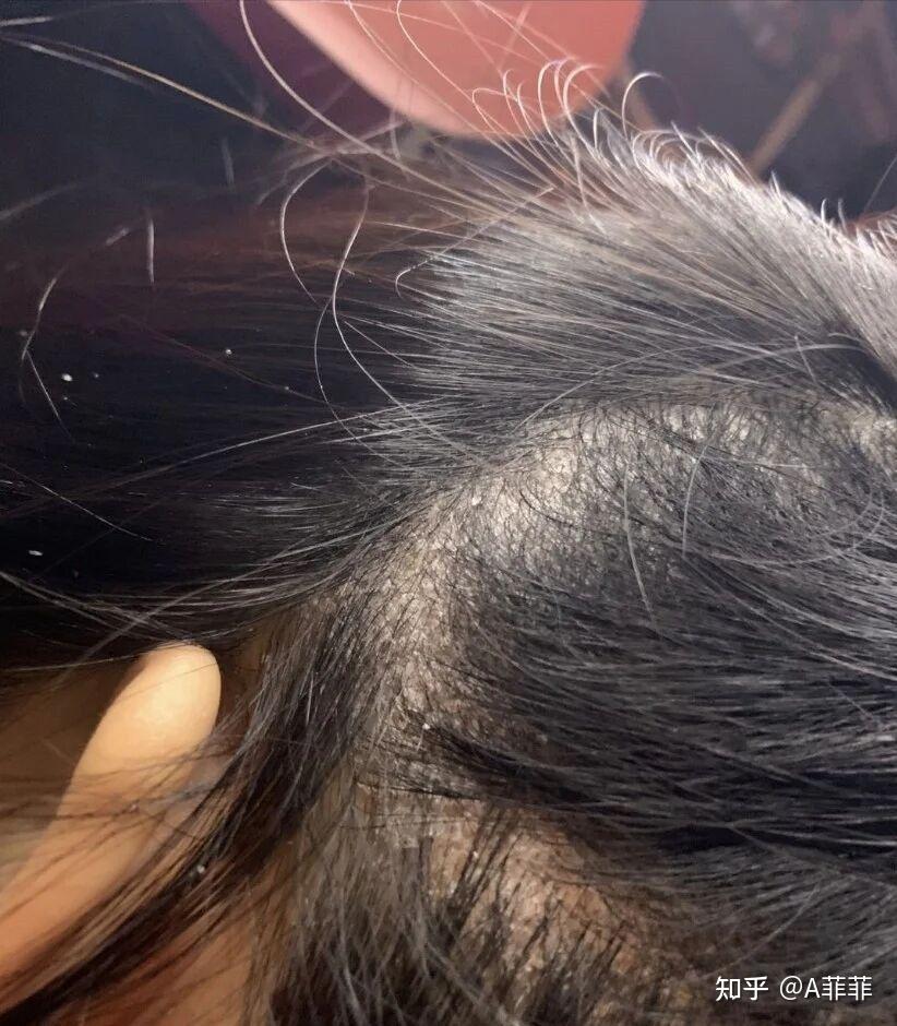 头部脂溢性皮炎求推荐的洗发水很多洗发水都过敏