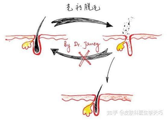 永久性脫毛是靠熱能傳遞來破壞毛乳頭部的生髮區的色素細胞來達到脫毛