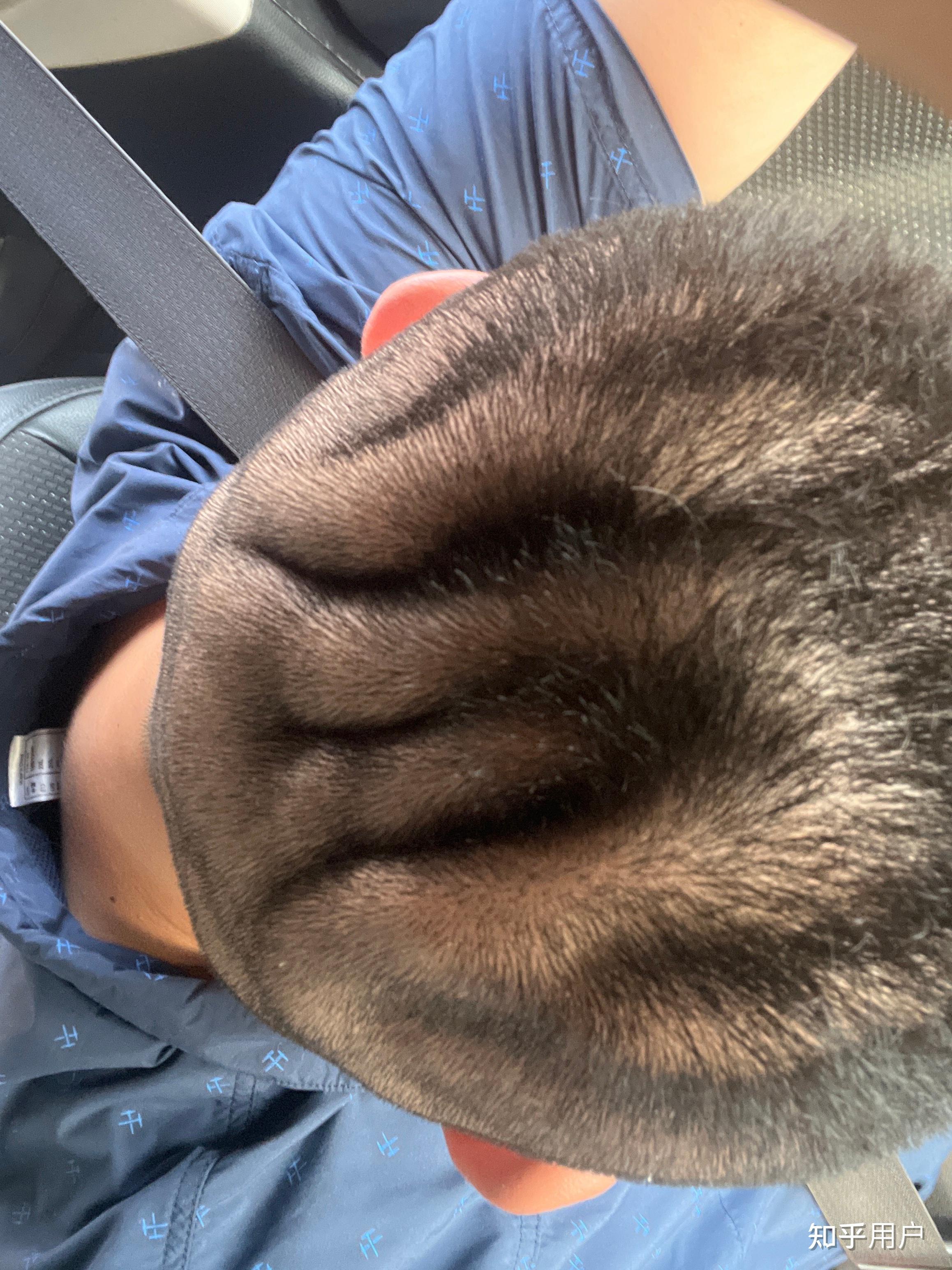 头皮有好多沟怎么回事能治疗吗