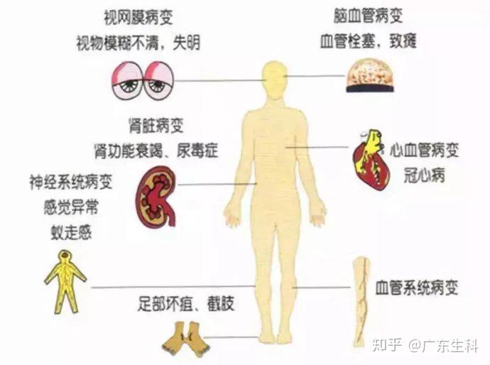 她的身体已开始出现并发症:眼底出血,视物模糊;手脚无力,小腿胀痛发麻