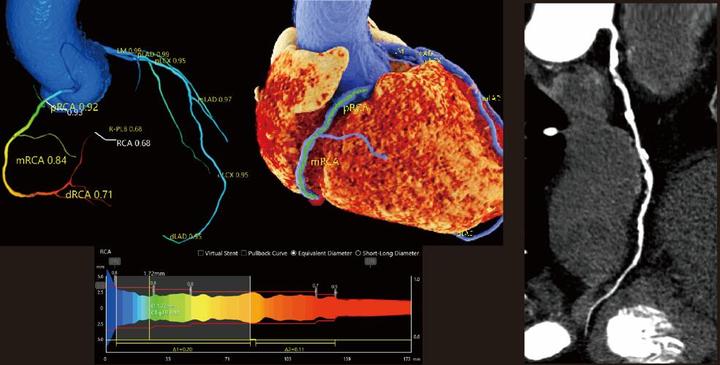 高尚医学影像之冠状动脉CT血流储备分数AI定量分析（CT-FFR） - 知乎