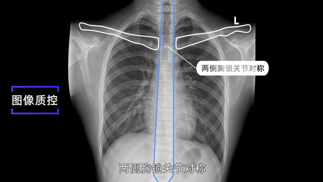 3 肺尖充分显示2 锁骨,乳房,左心房内可分辨出肺纹理