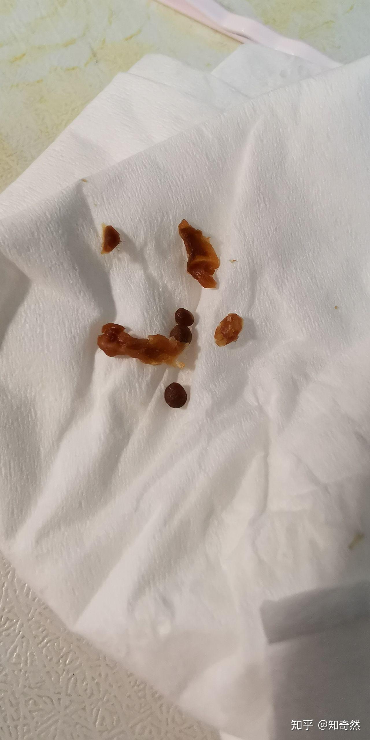 耳屎最大能有多大