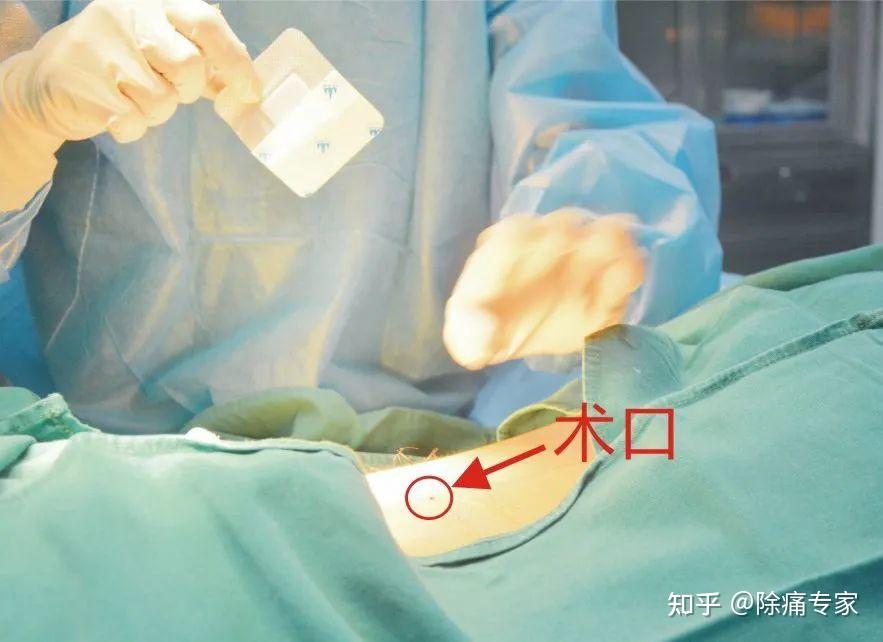 浅谈疼痛科治疗手段——小针刀 - 知乎