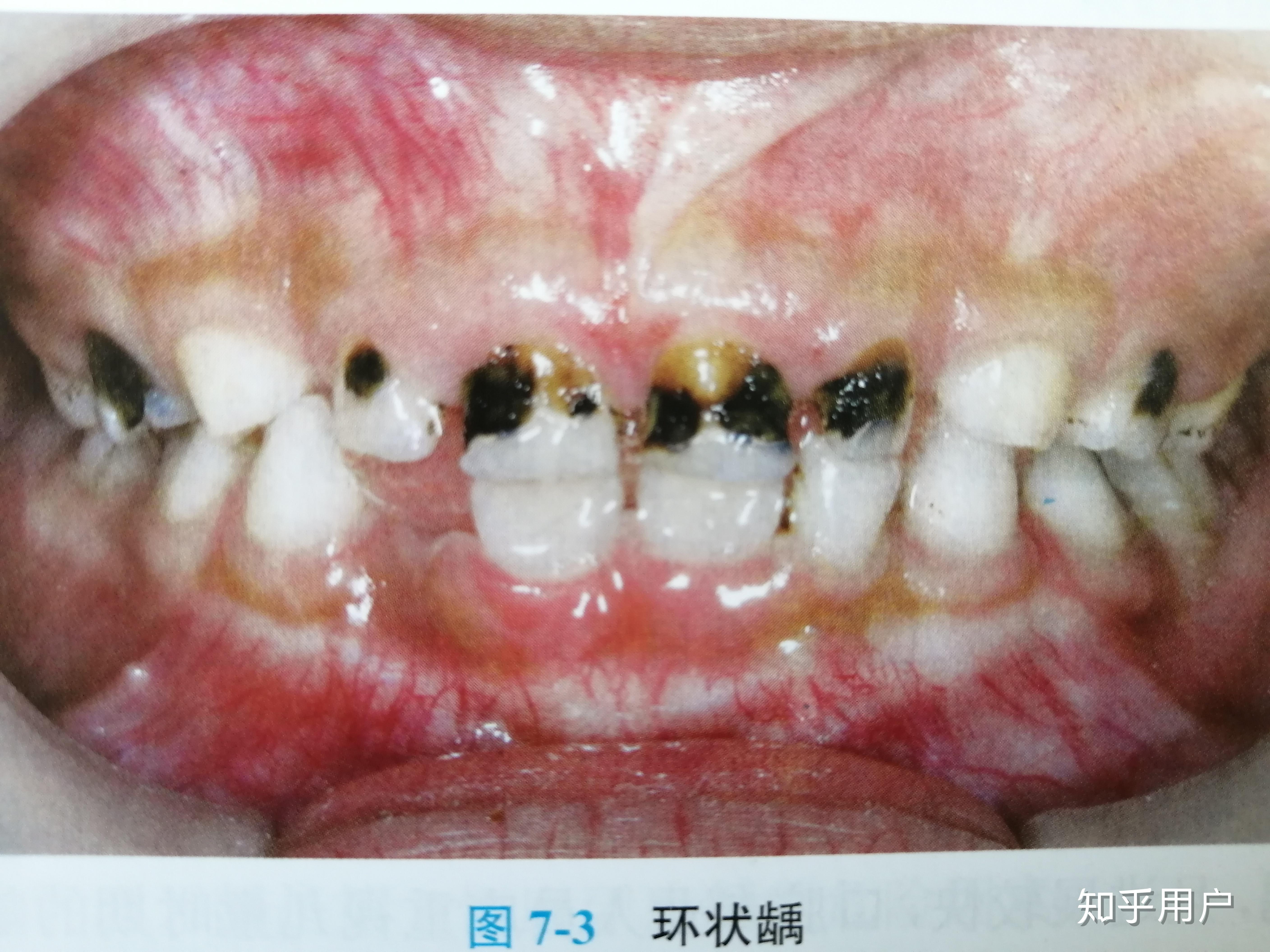 什么是奶瓶龋有什么症状如何预防和治疗