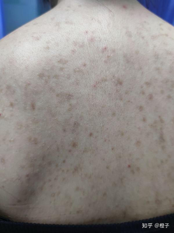 如何去背部痘痘及痘印 - 知乎