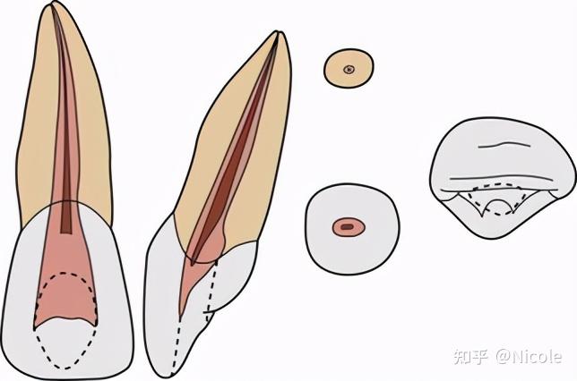 兒童牙齒的上頜中切牙特殊根管構型