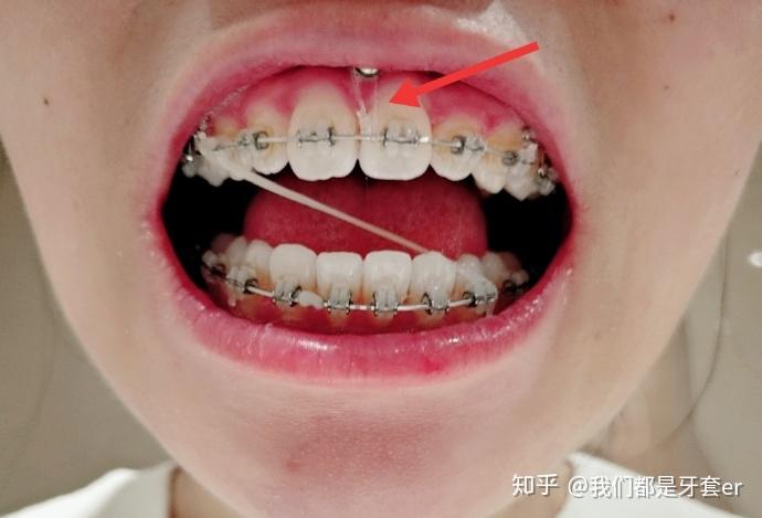 双颌前突,从小被叫大龅牙,不敢笑,历时8年说服家人才戴上牙套