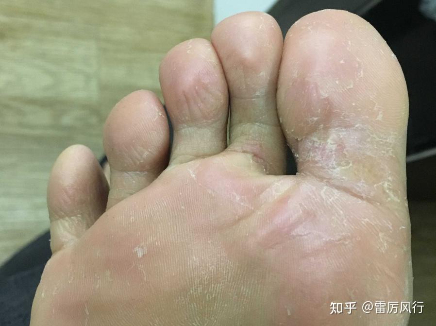 脚趾缝很痒还痛,是足藓吗? - 知乎